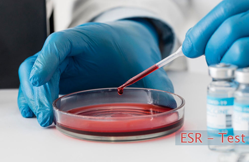 What is an ESR test, and what is the purpose? 
