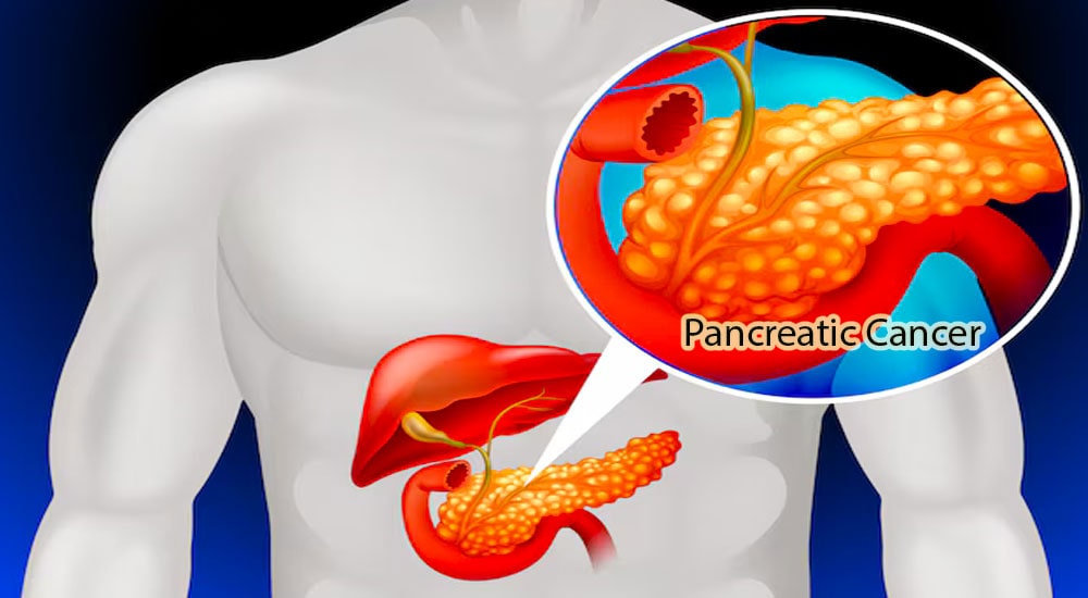 Everything you need to know about pancreatic cancer