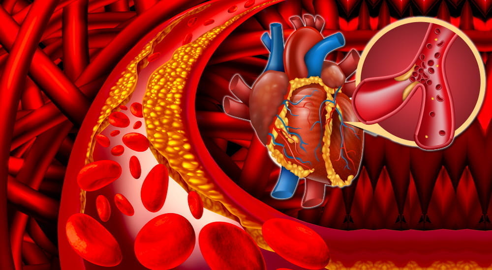 How to decrease triglycerides : 5 practical ways