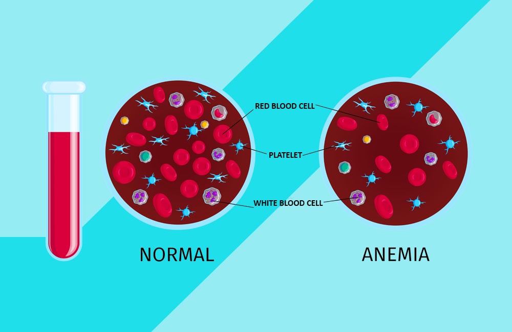 All you need to know about iron deficiency anemia  